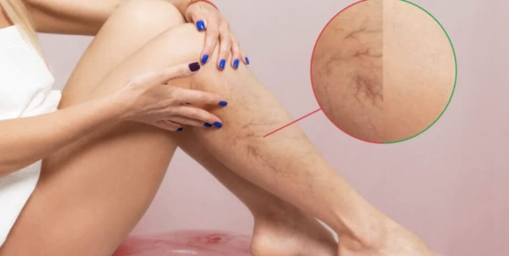 GUIA COMPLETO DE TRATAMENTO DE VARIZES