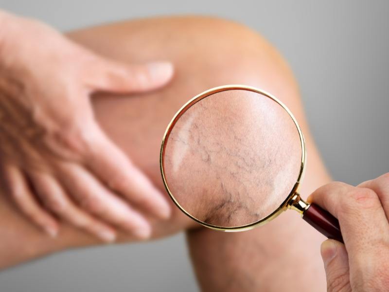 Tudo o Que Você Precisa Saber Sobre Varizes: Causas, Sintomas, Complicações e Tratamentos